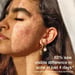 SKOG Acne Clarifying Gel: Targeted Treatment For Clearer Skin (30Ml)