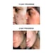 SKOG Acne Clarifying Gel: Targeted Treatment For Clearer Skin (30Ml)